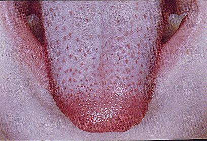 还出现舌头红肿发炎,味蕾颗颗分明的危险征兆草莓舌,如果不尽速就医