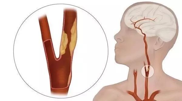 养生 救命 1/3中老年人都有"颈动脉斑块"医生公开自救法 全身的血液