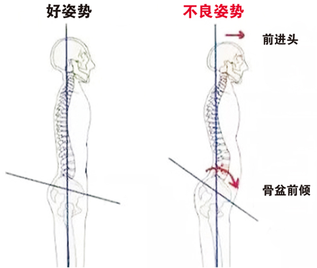 右边为骨盆前倾