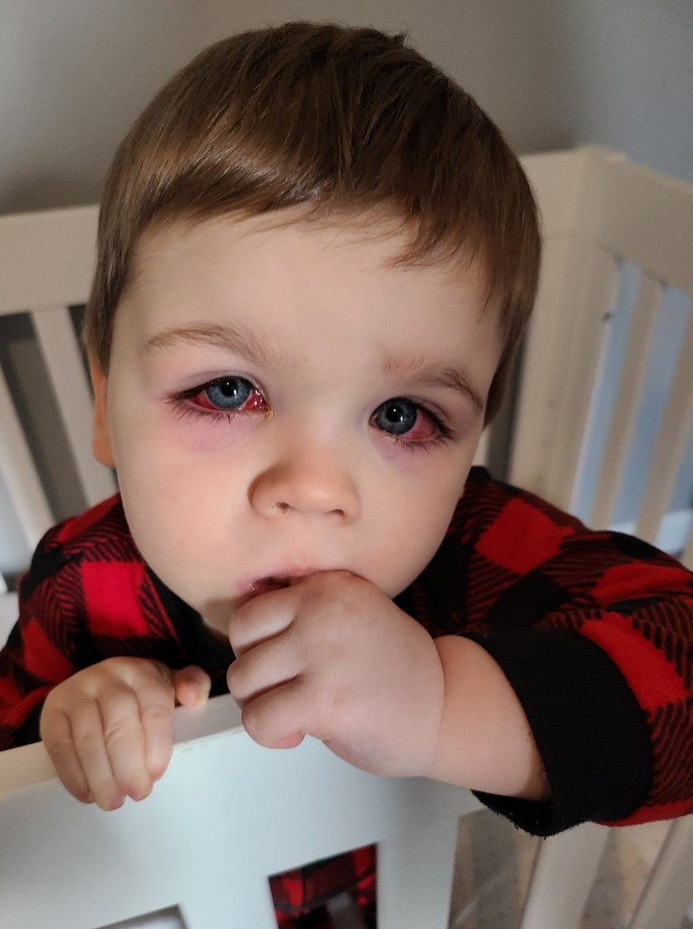 男童双眼红肿发烧 细菌入眼险失明