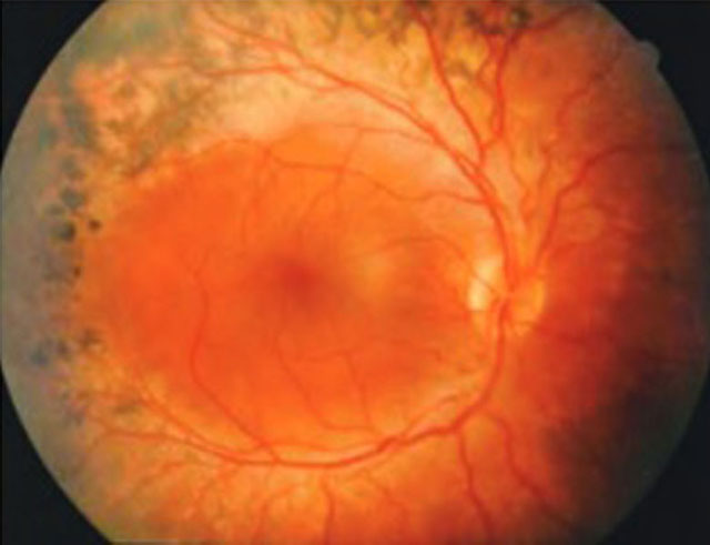 部分人的视杆细胞天生有功能缺失，造成先天性的夜盲症。