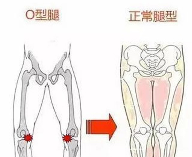 跷二郎腿会增加负重腿患骨关节炎的风险。