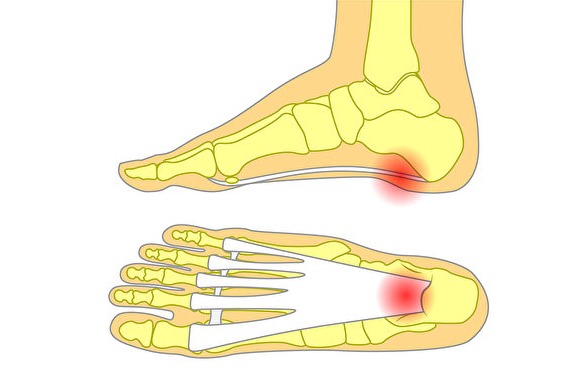 足底筋膜炎患者的脚跟骨与韧带衔接处长期承受压力及拉力，因而受伤，会引发骨刺。