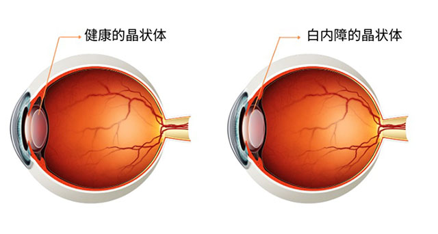 白内障是一种退化性疾病，随着年龄的增长还有眼睛的退化，晶状体会渐渐的变质、硬化和浑浊而导致白内障。