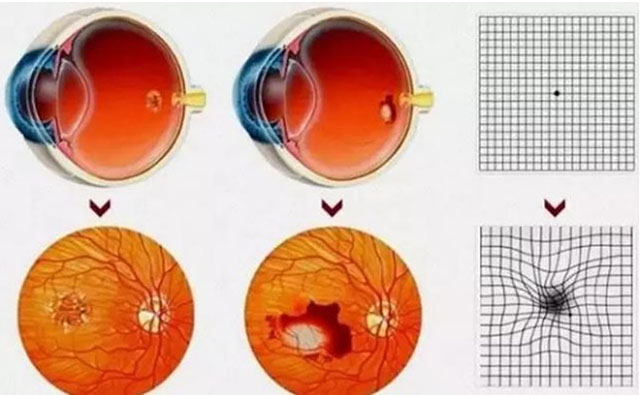 说起黄斑病变，它位于视网膜中心，能够准确识别形状、大小、颜色、纵深、距离等大多数光学信号，负责人眼睛的中心视力，是眼睛视力最敏感的区域。