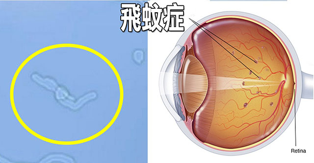 “飞蚊症”是指浮现在你眼球中的飘浮物，它们可能呈现为斑点、弯曲的线，或蜘蛛网形状的半透明影像。