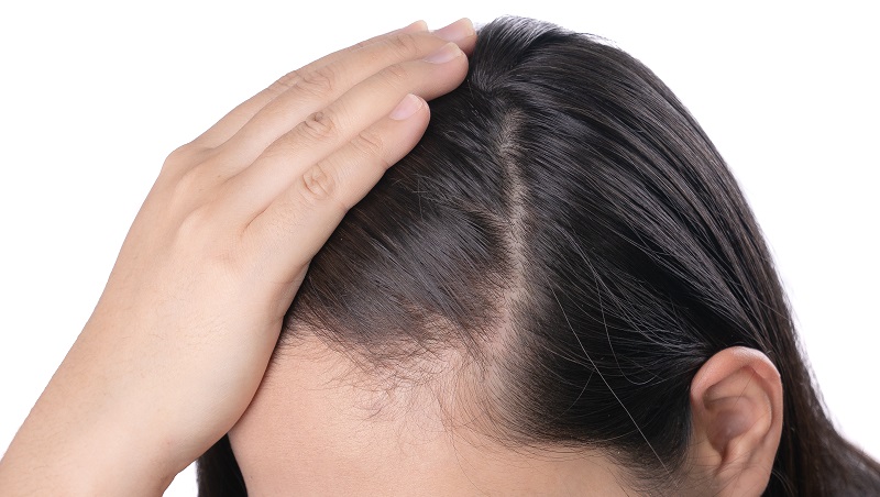 Young,Asian,Women,Worry,About,Problem,Hair,Loss,head,Bald,dandruff.hair,Loss