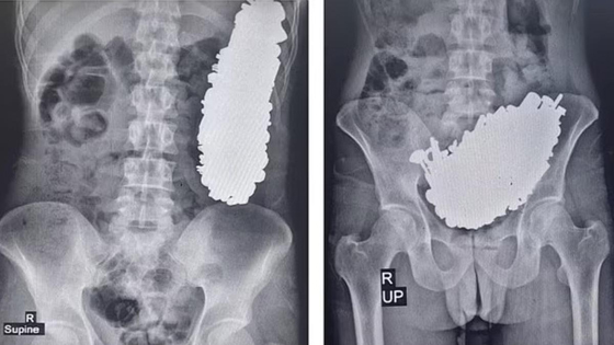 医生帮这名男子照X光片后，惊讶地发现其胃部竟塞满超过6磅（约3公斤）的金属制品。
